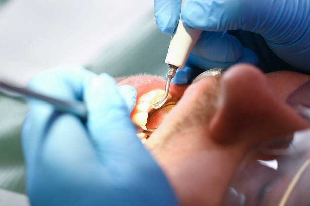 Best Emergency Wisdom Tooth Extraction in Concord, VA